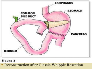Reconstruction after Classic Whipple Resection 