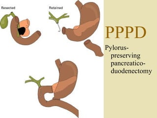 PPPD Pylorus-preserving  pancreatico- duodenectomy                                                                            