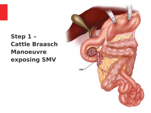 Whipple s Procedure Indications Steps Complications