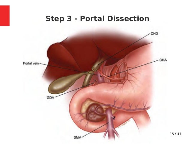Whipple s Procedure Indications Steps Complications