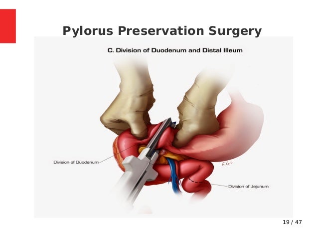 Whipple s Procedure Indications Steps Complications