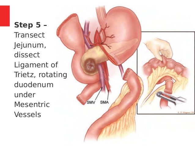 Whipple s Procedure Indications Steps Complications