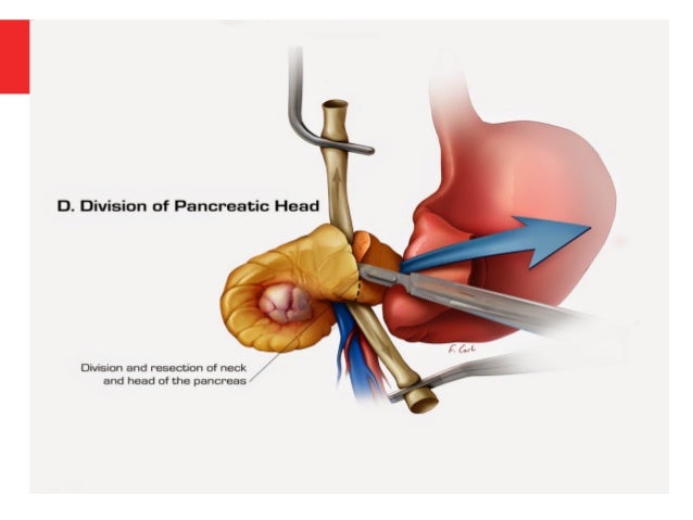 Whipple s Procedure Indications Steps Complications