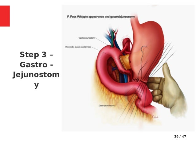 Whipple s Procedure Indications Steps Complications