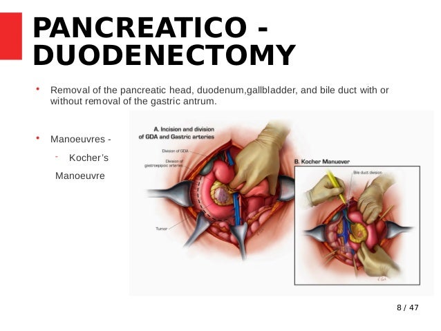Whipple s Procedure Indications Steps Complications