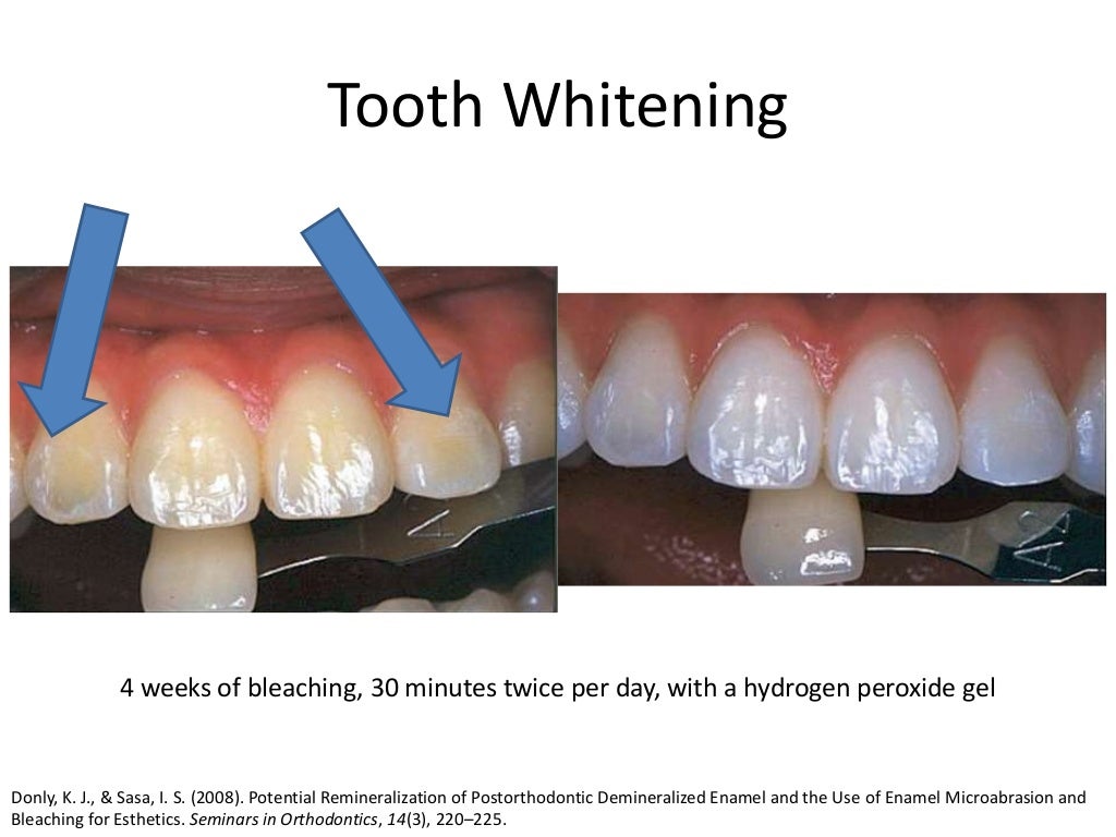 White Spot Lesions Braces