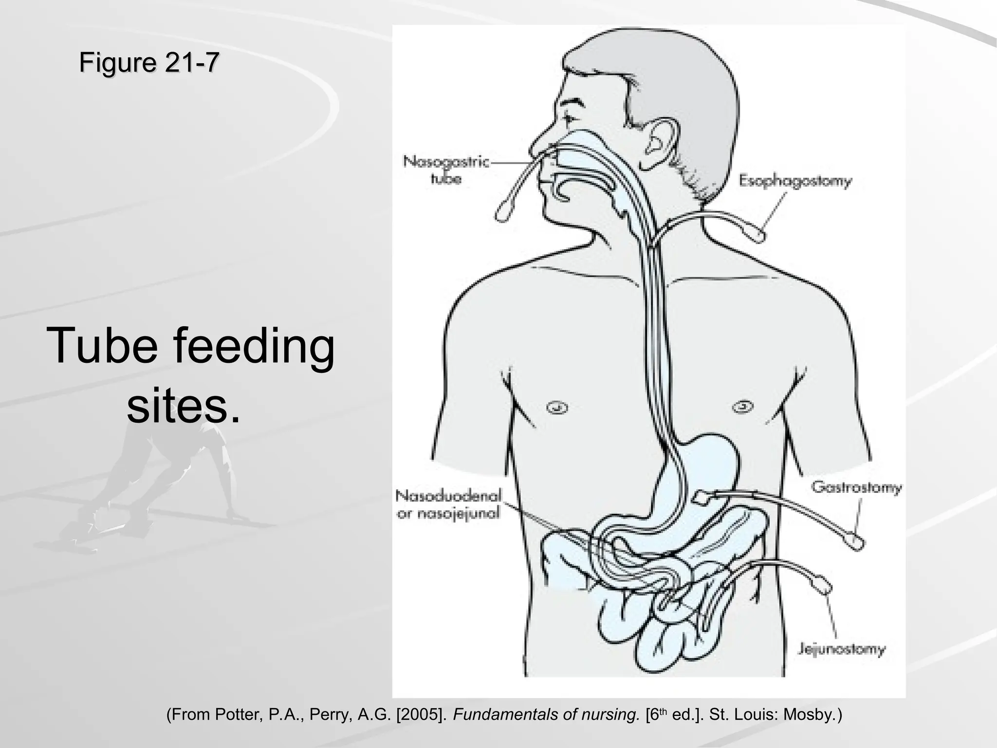 Figure 21-7
Figure 21-7
Tube feeding
sites.
(From Potter, P.A., Perry, A.G. [2005]. Fundamentals of nursing. [6th
ed.]. St. Louis: Mosby.)
 