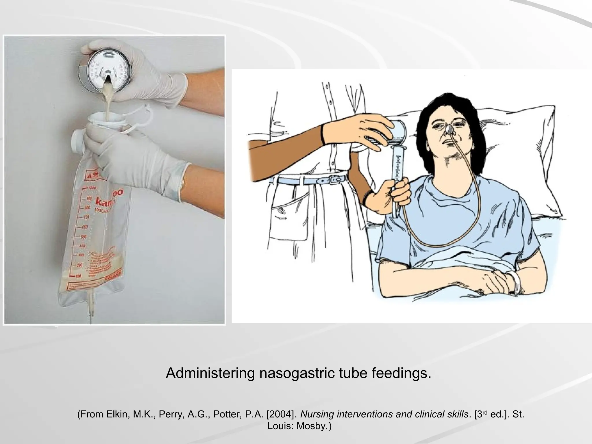 Administering nasogastric tube feedings.
(From Elkin, M.K., Perry, A.G., Potter, P.A. [2004]. Nursing interventions and clinical skills. [3rd
ed.]. St.
Louis: Mosby.)
 