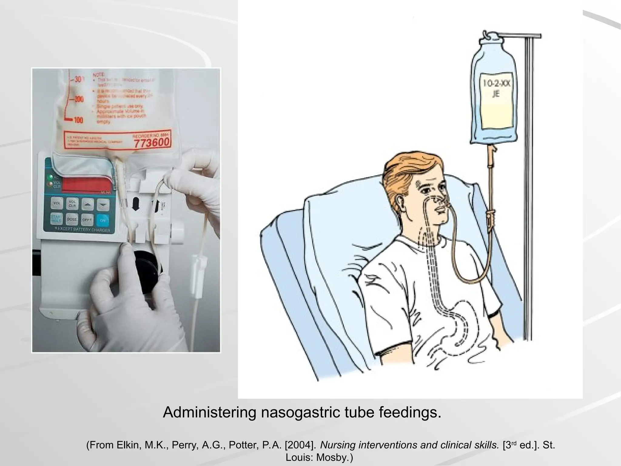 Administering nasogastric tube feedings.
(From Elkin, M.K., Perry, A.G., Potter, P.A. [2004]. Nursing interventions and clinical skills. [3rd
ed.]. St.
Louis: Mosby.)
 