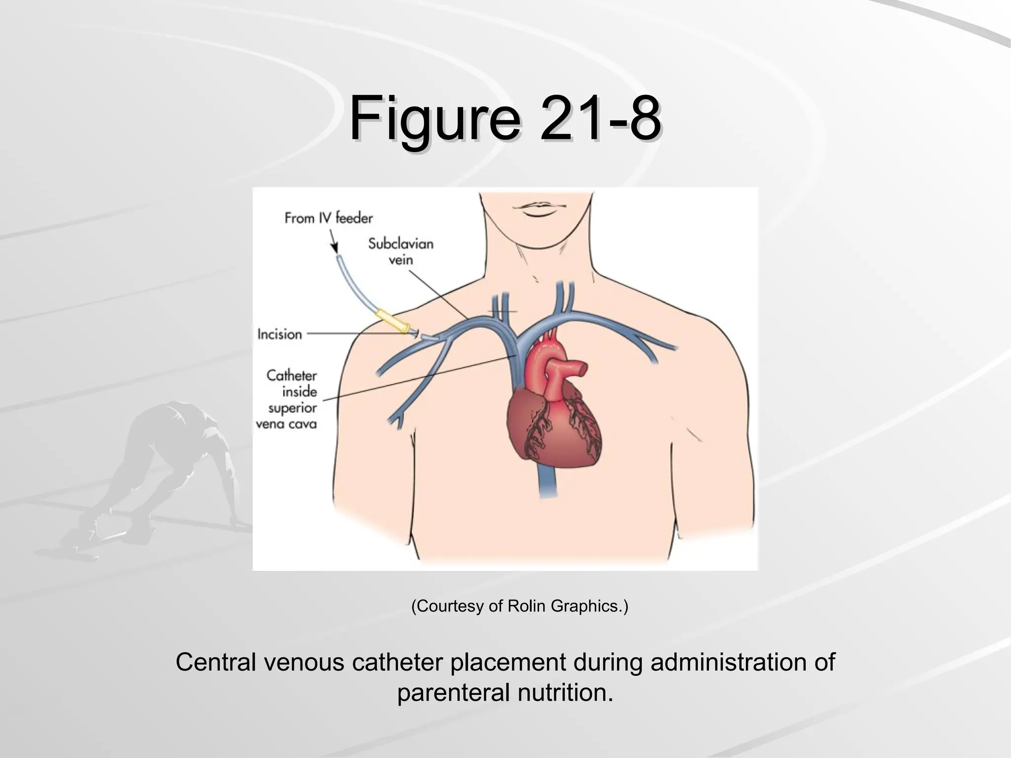 Figure 21-8
Figure 21-8
Central venous catheter placement during administration of
parenteral nutrition.
(Courtesy of Rolin Graphics.)
 