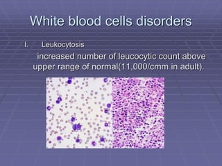 White blood cells disorders
I. Leukocytosis
increased number of leucocytic count above
upper range of normal(11,000/cmm in adult).
 