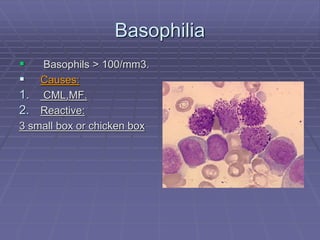 Basophilia
 Basophils > 100/mm3.
 Causes:
1. CML,MF.
2. Reactive:
3 small box or chicken box
 