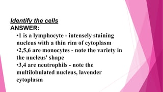 Identify the cells
ANSWER:
•1 is a lymphocyte - intensely staining
nucleus with a thin rim of cytoplasm
•2,5,6 are monocytes - note the variety in
the nucleus' shape
•3,4 are neutrophils - note the
multilobulated nucleus, lavender
cytoplasm
 