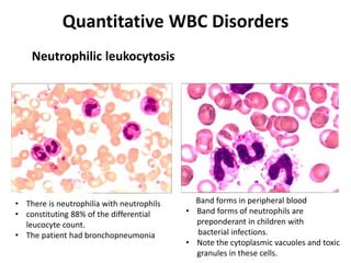 Quantitative WBC Disorders
Neutrophilic leukocytosis
• There is neutrophilia with neutrophils
• constituting 88% of the differential
leucocyte count.
• The patient had bronchopneumonia
Band forms in peripheral blood
• Band forms of neutrophils are
preponderant in children with
bacterial infections.
• Note the cytoplasmic vacuoles and toxic
granules in these cells.
 