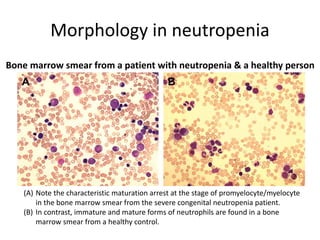 Morphology in neutropenia
(A) Note the characteristic maturation arrest at the stage of promyelocyte/myelocyte
in the bone marrow smear from the severe congenital neutropenia patient.
(B) In contrast, immature and mature forms of neutrophils are found in a bone
marrow smear from a healthy control.
Bone marrow smear from a patient with neutropenia & a healthy person
 