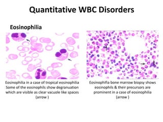 Quantitative WBC Disorders
Eosinophilia
Eosinophilia in a case of tropical eosinophilia
Some of the eosinophils show degranuation
which are visible as clear vacuole like spaces
(arrow )
Eosinophifia bone marrow biopsy shows
eosinophils & their precursors are
prominent in a case of eosinophilia
(arrow )
 