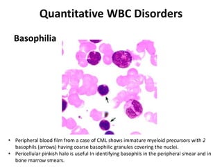 Quantitative WBC Disorders
Basophilia
• Peripheral blood film from a case of CML shows immature myeloid precursors with 2
basophils (arrows) having coarse basophilic granules covering the nuclei.
• Pericellular pinkish halo is useful In identifying basophils in the peripheral smear and in
bone marrow smears.
 