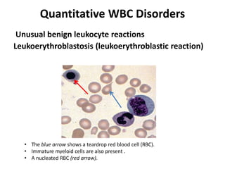 Quantitative WBC Disorders
Leukoerythroblastosis (leukoerythroblastic reaction)
• The blue arrow shows a teardrop red blood cell (RBC).
• Immature myeloid cells are also present .
• A nucleated RBC (red arrow).
Unusual benign leukocyte reactions
 