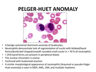 PELGER-HUET ANOMALY
• A benign autosomal dominant anomaly of leukocytes.
• Neutrophils demonstrate lack of segmentation of nuclei with bilobed/band
forms/dumb-bell shaped/smooth rounded small nuclei in > 70 % of neutrophils.
• < 25% band forms are present in peripheral blood.
• The nuclear chromatin is coarse.
• Confused with leukemoid reaction.
• A similar morphological appearance of neutrophils (Acquired or pseudo-Felger
Huet anomaly) is seen in MDS. AML, CML and multiple myeloma.
 