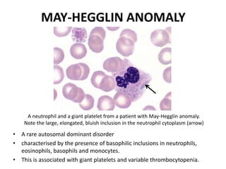 MAY-HEGGLIN ANOMALY
• A rare autosomal dominant disorder
• characterised by the presence of basophilic inclusions in neutrophils,
eosinophils, basophils and monocytes.
• This is associated with giant platelets and variable thrombocytopenia.
A neutrophil and a giant platelet from a patient with May-Hegglin anomaly.
Note the large, elongated, bluish inclusion in the neutrophil cytoplasm (arrow)
 