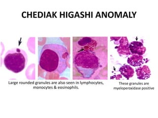 CHEDIAK HIGASHI ANOMALY
Large rounded granules are also seen in lymphocytes,
monocytes & eosinophils.
These granules are
myeloperoxidase positive
 