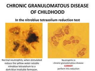 CHRONIC GRANULOMATOUS DISEASE
OF CHILDHOOD
Normal neutrophils, when stimulated
reduce the yellow water-soluble
nitroblue tetrazolium to a
dark blue insoluble formazan.
In the nitroblue tetrazolium reduction test
Neutrophils in
chronic granulomatous disease
CANNOT
perform this reduction
 