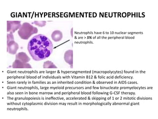 GIANT/HYPERSEGMENTED NEUTROPHILS
• Giant neutrophils are larger & hypersegmented (macropolycytes) found in the
peripheral blood of individuals with Vitamin B12 & folic acid deficiency.
• Seen rarely in families as an inherited condition & observed in AIDS cases.
• Giant neutrophils, large myeloid precursors and few binucleate promyelocytes are
also seen in bone marrow and peripheral blood following G-CSF therapy.
• The granulopoiesis is ineffective, accelerated & skipping of 1 or 2 mitotic divisions
without cytoplasmic division may result in morphologically abnormal giant
neutrophils.
Neutrophils have 6 to 10 nuclear segments
& are > 5% of all the peripheral blood
neutrophils.
 