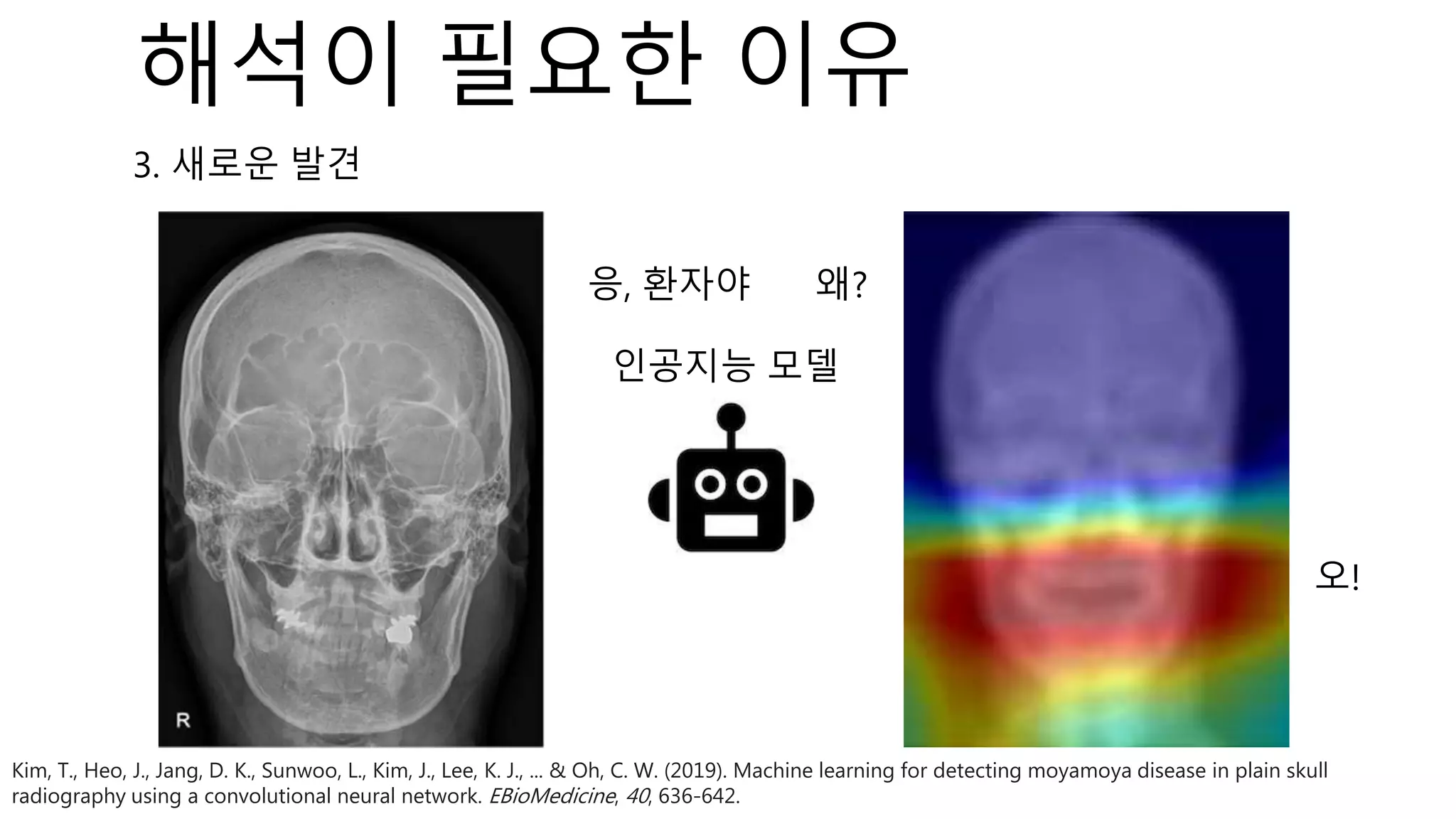 인공지능 모델
응, 환자야 왜?
Kim, T., Heo, J., Jang, D. K., Sunwoo, L., Kim, J., Lee, K. J., ... & Oh, C. W. (2019). Machine learning for detecting moyamoya disease in plain skull
radiography using a convolutional neural network. EBioMedicine, 40, 636-642.
오!
3. 새로운 발견
해석이 필요한 이유
 