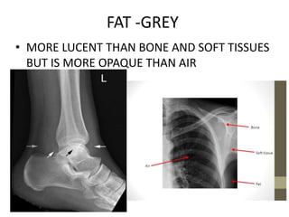 FAT -GREY
• MORE LUCENT THAN BONE AND SOFT TISSUES
BUT IS MORE OPAQUE THAN AIR
 