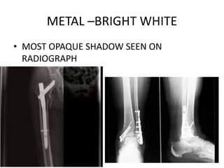 METAL –BRIGHT WHITE
• MOST OPAQUE SHADOW SEEN ON
RADIOGRAPH
 