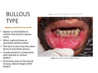 white lesions.pptx