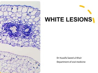 WHITE LESIONS
Dr Huzaifa Saeed ul Khair
Department of oral medicine
 