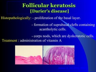 Oral White Lesions PPT Oral White Lesions PPT