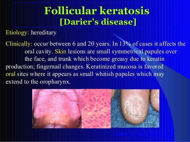 Oral White Lesions Oral White Lesions