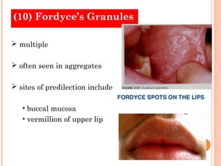 (10) Fordyce’s Granules

 multiple

 often seen in aggregates

 sites of predilection include

   • buccal mucosa
   • vermillion of upper lip
 