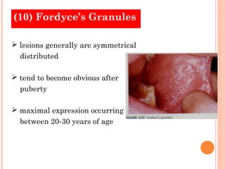 (10) Fordyce’s Granules

 lesions generally are symmetrical
  distributed

 tend to become obvious after
  puberty

 maximal expression occurring
  between 20-30 years of age
 