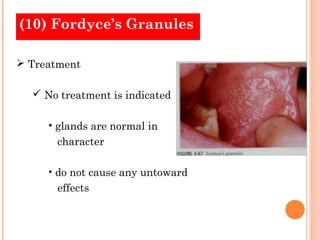 (10) Fordyce’s Granules

 Treatment

   No treatment is indicated

     • glands are normal in
       character

     • do not cause any untoward
       effects
 