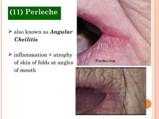(11) Perleche

 also known as Angular
  Cheilitis

 inflammation + atrophy
  of skin of folds at angles
  of mouth
 