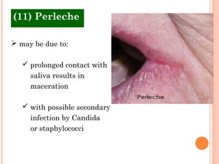 (11) Perleche

 may be due to:

    prolonged contact with
     saliva results in
     maceration

    with possible secondary
     infection by Candida
     or staphylococci
 