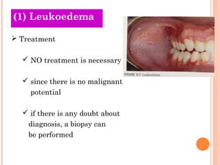 (1) Leukoedema

 Treatment

   NO treatment is necessary

   since there is no malignant
    potential

   if there is any doubt about
    diagnosis, a biopsy can
    be performed
 