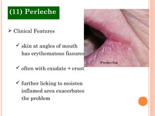 (11) Perleche

 Clinical Features

    skin at angles of mouth
     has erythematous fissures

    often with exudate + crust

    further licking to moisten
     inflamed area exacerbates
     the problem
 