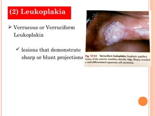 (2) Leukoplakia

 Verrucous or Verruciform
  Leukoplakia

    lesions that demonstrate
     sharp or blunt projections
 