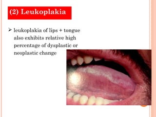 (2) Leukoplakia

 leukoplakia of lips + tongue
  also exhibits relative high
  percentage of dysplastic or
  neoplastic change
 