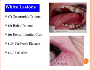 White Lesions

 (7) Geographic Tongue

 (8) Hairy Tongue

 (9) Dental Lamina Cyst

 (10) Fordyce’s Disease

 (11) Perleche
 