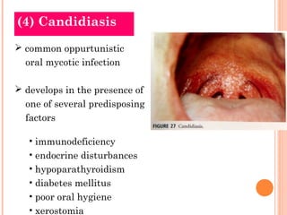 (4) Candidiasis
 common oppurtunistic
  oral mycotic infection

 develops in the presence of
  one of several predisposing
  factors

   • immunodeficiency
   • endocrine disturbances
   • hypoparathyroidism
   • diabetes mellitus
   • poor oral hygiene
   • xerostomia
 