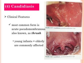 (4) Candidiasis

 Clinical Features

    most common form is
     acute pseudomembranous
     also known, as thrush

      • young infants + elderly
       are commonly affected
 