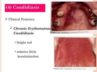 (4) Candidiasis

 Clinical Features

    Chronic Erythematous
     Candidiasis

      • bright red

      • relative little
        keratinization
 