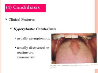 (4) Candidiasis

 Clinical Features

    Hyperplastic Candidiasis

      • usually asymptomatic

      • usually discovered on
       routine oral
       examination
 