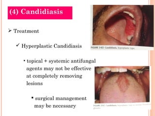 (4) Candidiasis

 Treatment

   Hyperplastic Candidiasis

     • topical + systemic antifungal
      agents may not be effective
      at completely removing
      lesions

         surgical management
         may be necessary
 