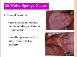 (5) White Sponge Nevus

 Clinical Features

   • presentation intraorally
    is almost always bilateral
    + symmetric

   • usually appears early in
    life, typically before
    puberty
 